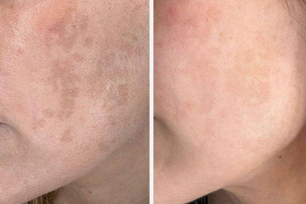 Revolusi Serum: Atasi Noda Gelap dengan Efektif